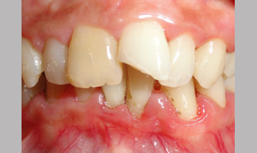Dentures treatment in Anand
                